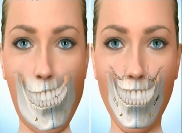 Cirugía Maxilofacial